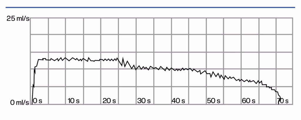 Typical uroflowmetry (urinary flow test) in urethral stricture with dysuria, flattened curve, low maximum flow rate and prolonged urination