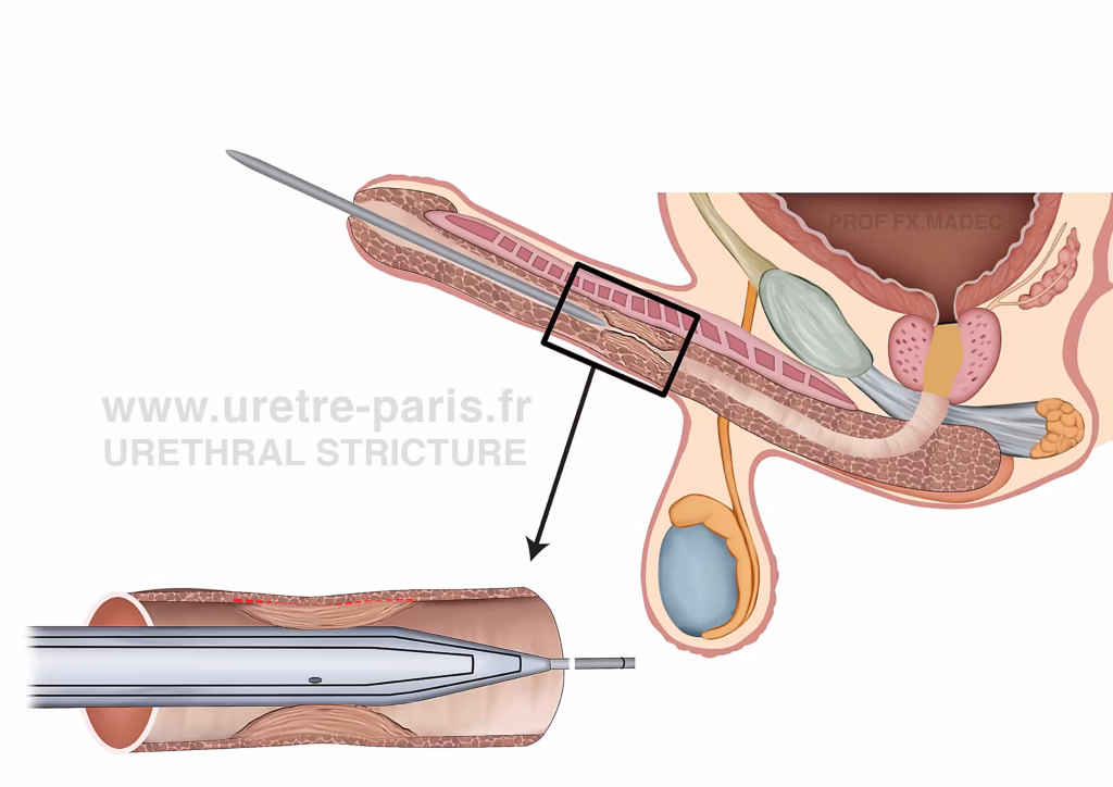 Schéma chirurgical détaillé illustrant le ballon enduit de paclitaxel Optilume comme traitement innovant de la sténose de l’urètre, montrant la dilatation urétrale endoscopique et la délivrance locale du médicament, illustration originale par URETRE PARIS