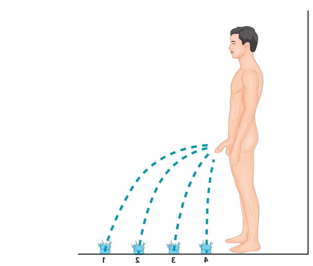 Sténose de l’urètre montrant une diminution progressive du jet urinaire de grade 1 à 4 — schéma explicatif d’un affaiblissement du débit en fonction du degré de rétrécissement urétral.