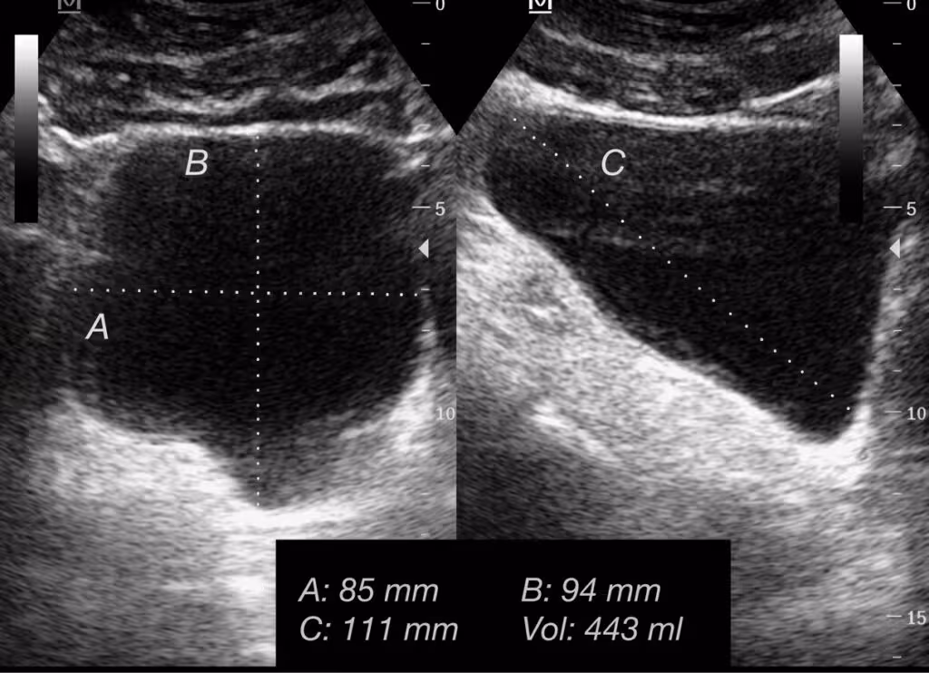 Échographie vésicale montrant un résidu post-mictionnel significatif chez un patient avec une sténose de l’urètre sévère, évocateur d’une obstruction urinaire