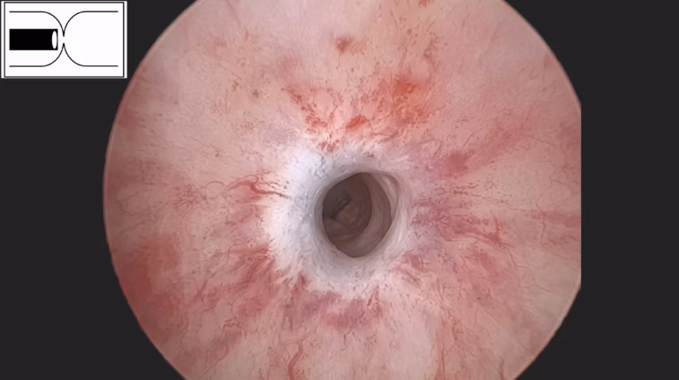Image cystoscopique typique d’une sténose urétrale sévère montrant un rétrécissement marqué du calibre urétral avec un aspect blanchâtre