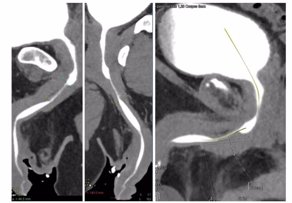 Scanner urétral spécialisé (computed tomography, CT) montrant une sténose de l’urètre, réalisé à URETRE PARIS dans le cadre d’un parcours expert d’évaluation des sténoses urétrales