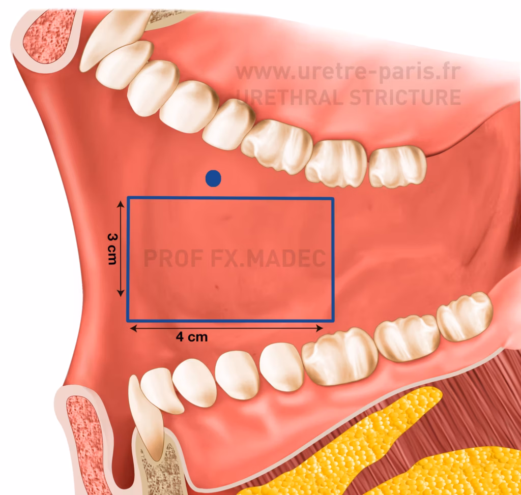 Schéma chirurgical illustrant le prélèvement de muqueuse buccale à la face interne de la joue, utilisée pour l’urétroplastie dans la reconstruction des sténoses de l’urètre