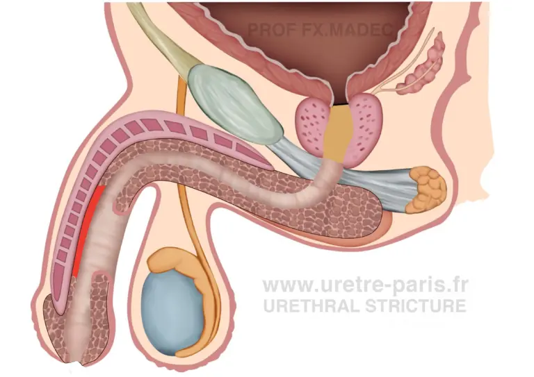Schéma chirurgical détaillé du premier temps d’une urétroplastie en deux temps pour sténose urétrale pénienne avec greffe de muqueuse buccale, illustrant la mise en place du greffon (mis en évidence en rouge) et la préparation à la reconstruction secondaire