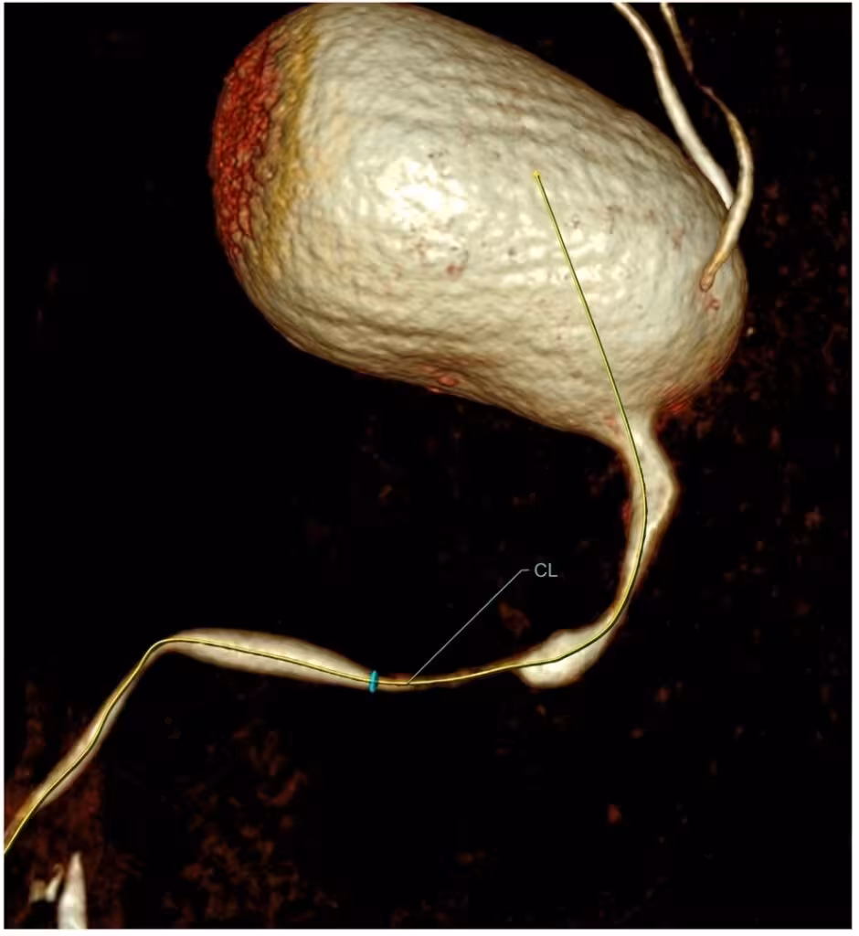 Reconstruction 3D avancée du scanner (CT) de l’urètre montrant une sténose de l’urètre, réalisée dans le cadre d’un parcours d’imagerie urétrale spécialisé à URETRE PARIS
