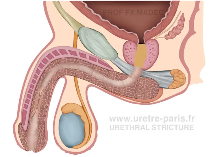 Sténose urétrale pénienne longue fréquemment observée après échec de réparation d’hypospadias, illustrant une situation complexe de reconstruction urétrale