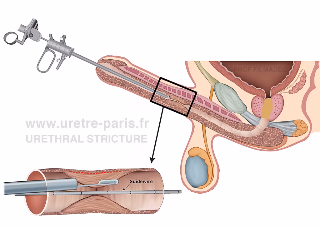 Schéma chirurgical détaillé illustrant l’urétrotomie interne sous contrôle visuel direct (DVIU), montrant l’incision endoscopique d’une sténose de l’urètre telle que réalisée lors des procédures d’urétrotomie endoscopique, illustration originale par URETRE PARIS