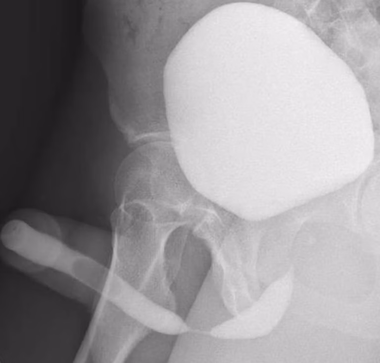 Image d’une sténose de l’urètre bulbaire très serrée, de plus de 2 cm, en urétrocystographie rétrograde et mictionnelle (UCRM)