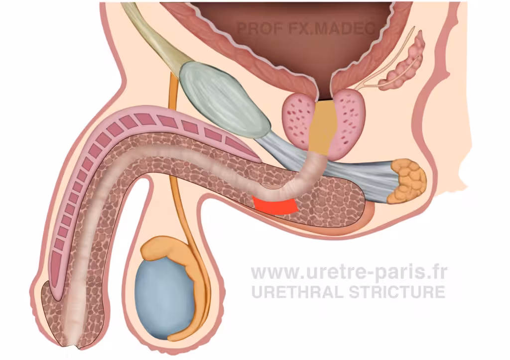 Schéma chirurgical détaillé d’une urétroplastie en onlay ventral avec greffe de muqueuse buccale pour sténose de l’urètre, illustrant une reconstruction en un temps avec la greffe mise en évidence en rouge sur la face ventrale