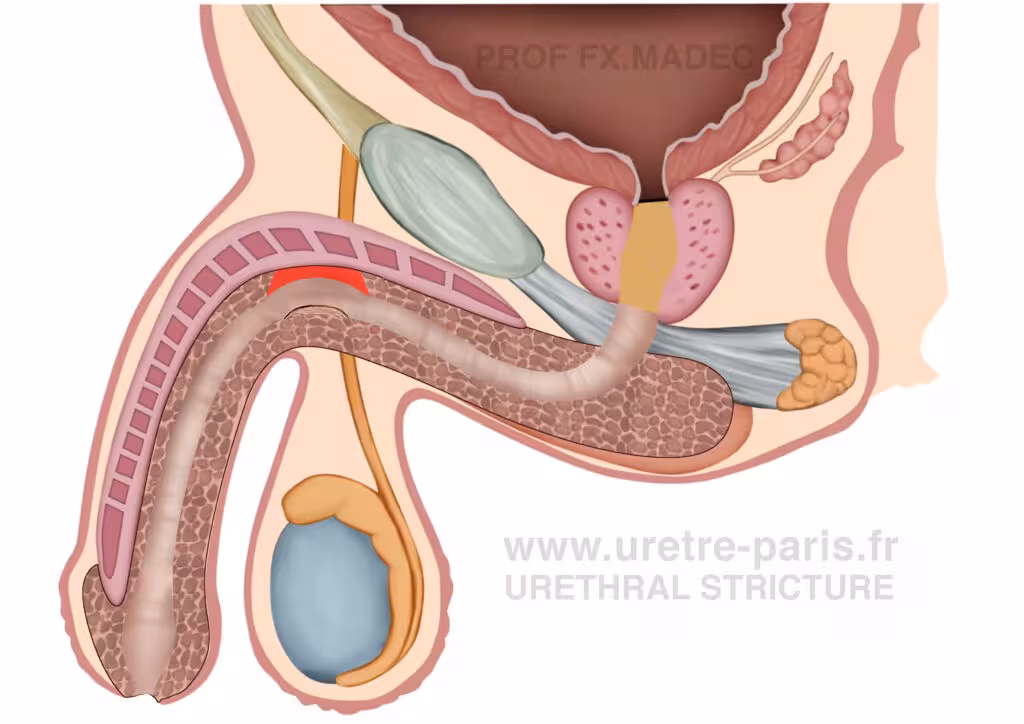 Schéma chirurgical détaillé d’une urétroplastie en onlay dorsal avec greffe de muqueuse buccale pour sténose de l’urètre, illustrant une reconstruction en un temps avec la greffe mise en évidence en rouge sur la face dorsale